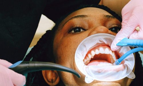 Vejen til et Smukt Smil: En Guide til Tandregulering
